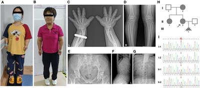 Case Report: Whole-exome sequencing identified two novel COMP variants causing pseudoachondroplasia